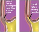 How To Prevent and Treat Heartburn or Acid Reflux The Easy Way