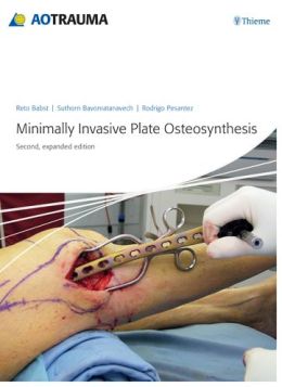 Minimally Invasive Plate Osteosynthesis (MIPO) Reto Babst, Suthorn Bavonratanavech and Rodrigo F. Pesantez